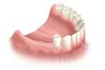 Dental Implants by Dr. David Richardson - Charleston South Carolina Implant Dentist