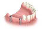 Dental Implants by Dr. David Richardson - Charleston South Carolina Implant Dentist