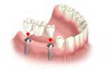 Dental Implants by Dr. David Richardson - Charleston South Carolina Implant Dentist