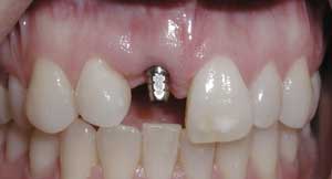 Dental Implants by Dr. David Richardson - Charleston South Carolina Dentist