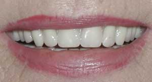 Dentures by Dr. David Richardson - Charleston SC Dentist