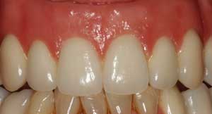 Dentures by Dr. David Richardson - Charleston SC Dentist